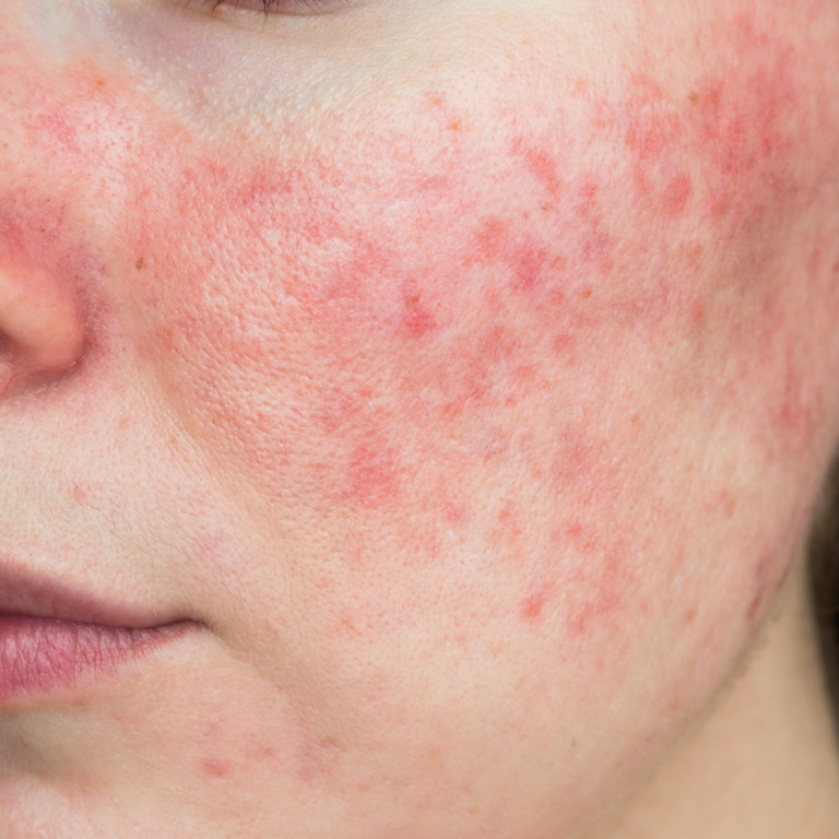 Natural Solutions for Rosacea: Understanding Causes and Embracing Effective Remedies